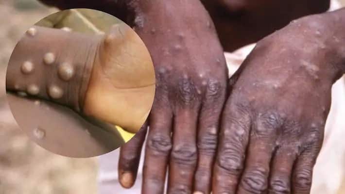 Is Monkeypox Life Threatening? No Drugs Avialable For Treatment Yet, But This Vaccine May Help